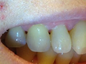 Recession that has progressed to the point that unsightly black spaces appear between the teeth. These are not only aesthetic problems, they are food traps as well. In Dr. Wong's case, this is not a typical case of periodontitis as oral hygiene is good.