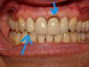 The areas of concern are pointed out. This case is now a cosmetic failure.
