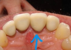 From the underside, we can also see some concerns from an open margin between the tooth and the crown. Ideally, there should be no gap. The gap was open enough that we could determine the presence of dental decay setting in under the crown.