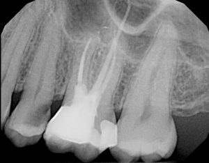 The post-operative root canal x-ray.  The gutta percha filling is easily visible, as is the filling material.  This tooth is still fragile, and should be protected with a restoration that provides cuspal coverage to prevent fracture.  This can be a crown or an onlay.  Our choice here would be an all-ceramic crown (e.max from Ivoclar at the moment).  