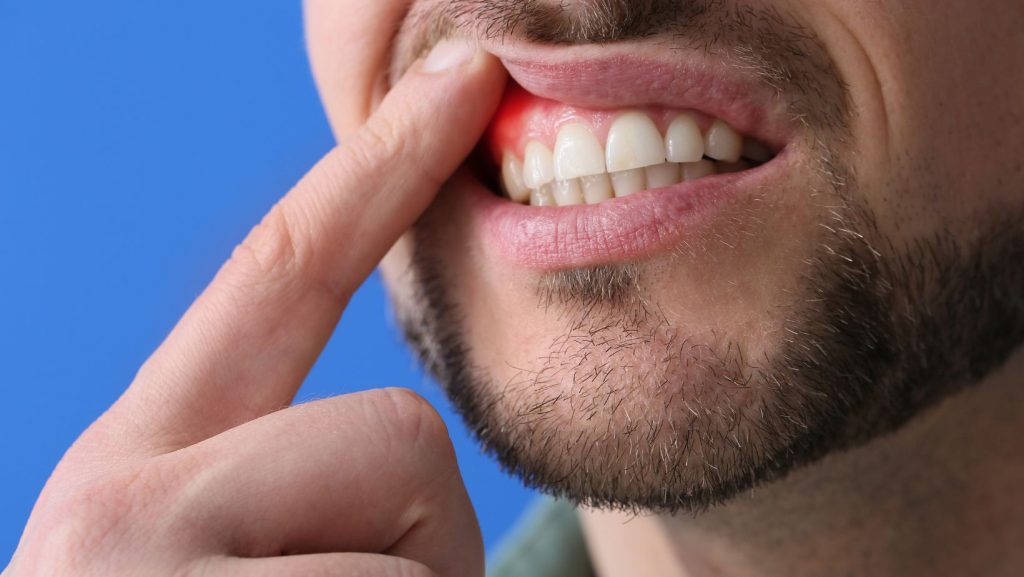 Gum Disease