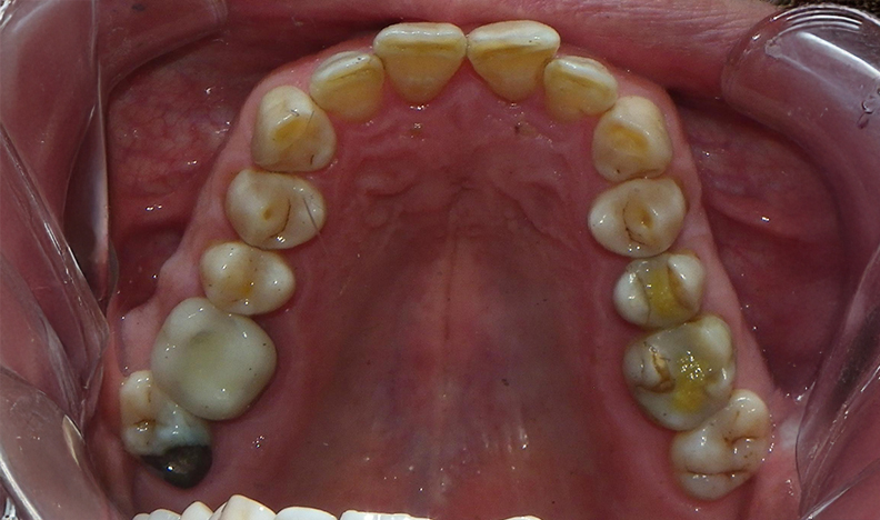 Front teeth showing natural enamel colour