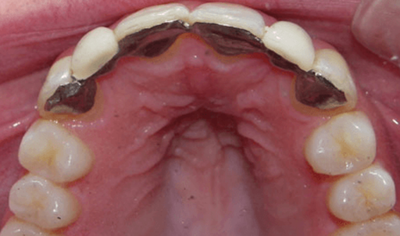 Upper arch with dental appliance visible