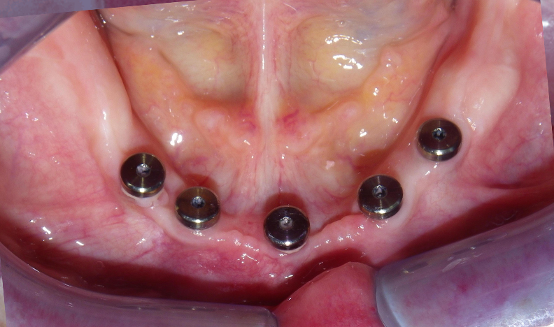 Dental mirror view of tooth surface