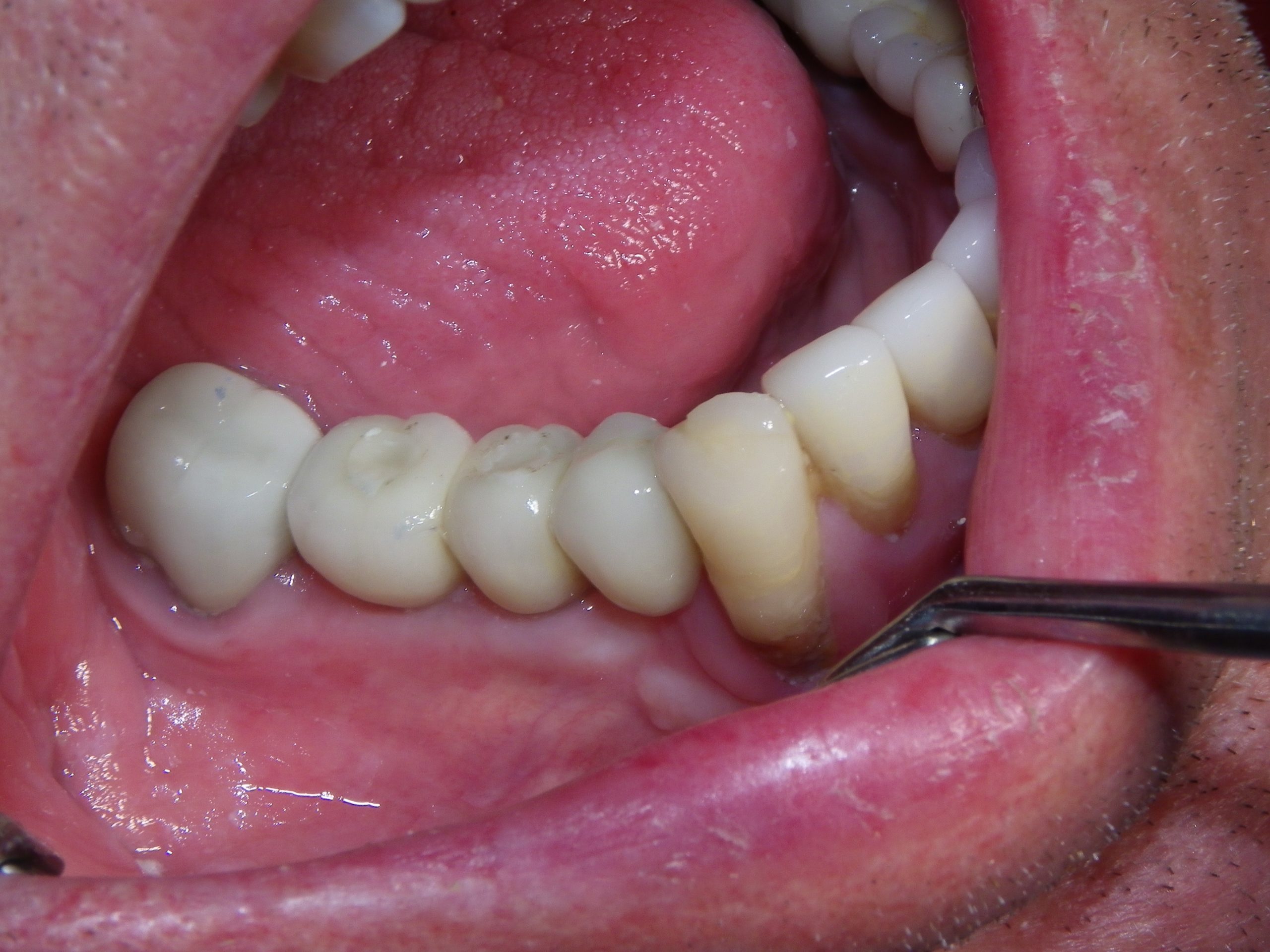 Intraoral image showing dental implant components