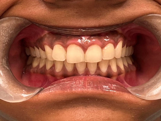 Teeth and gums viewed during routine dental check