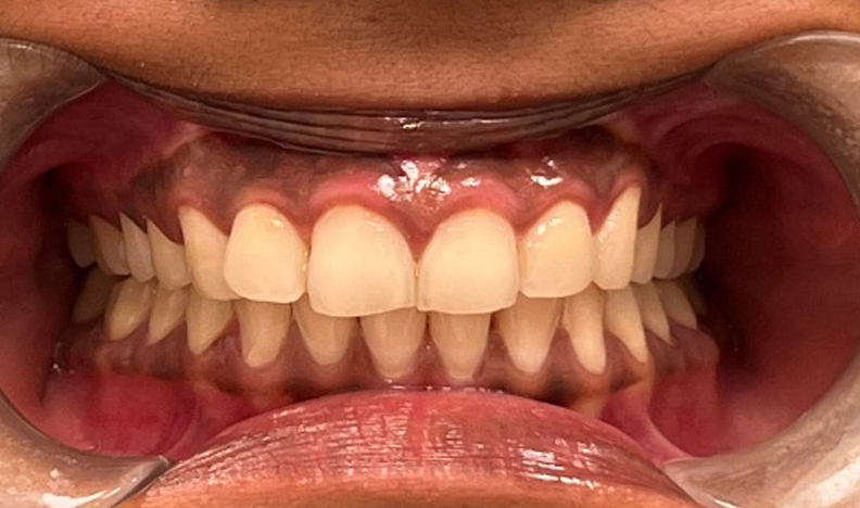 Side view of teeth showing bite alignment