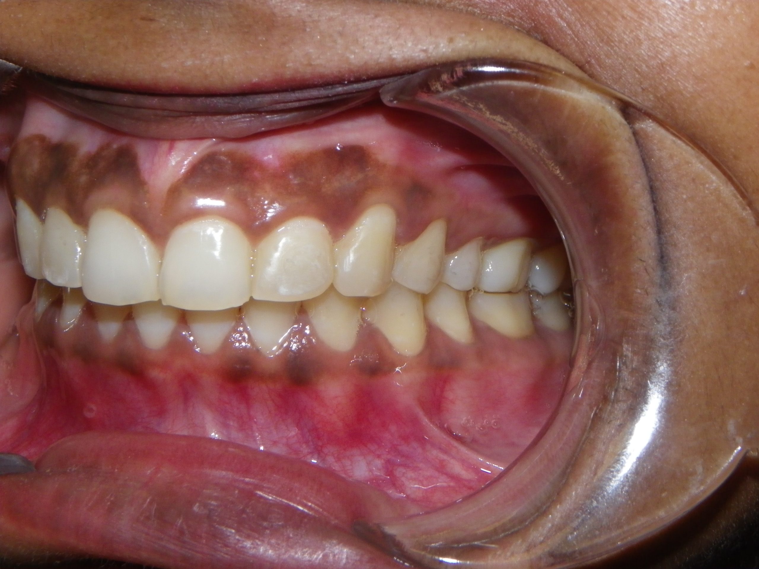 Close-up of teeth showing natural enamel texture