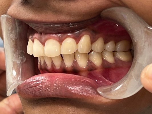 Smile showing even tooth alignment and colour