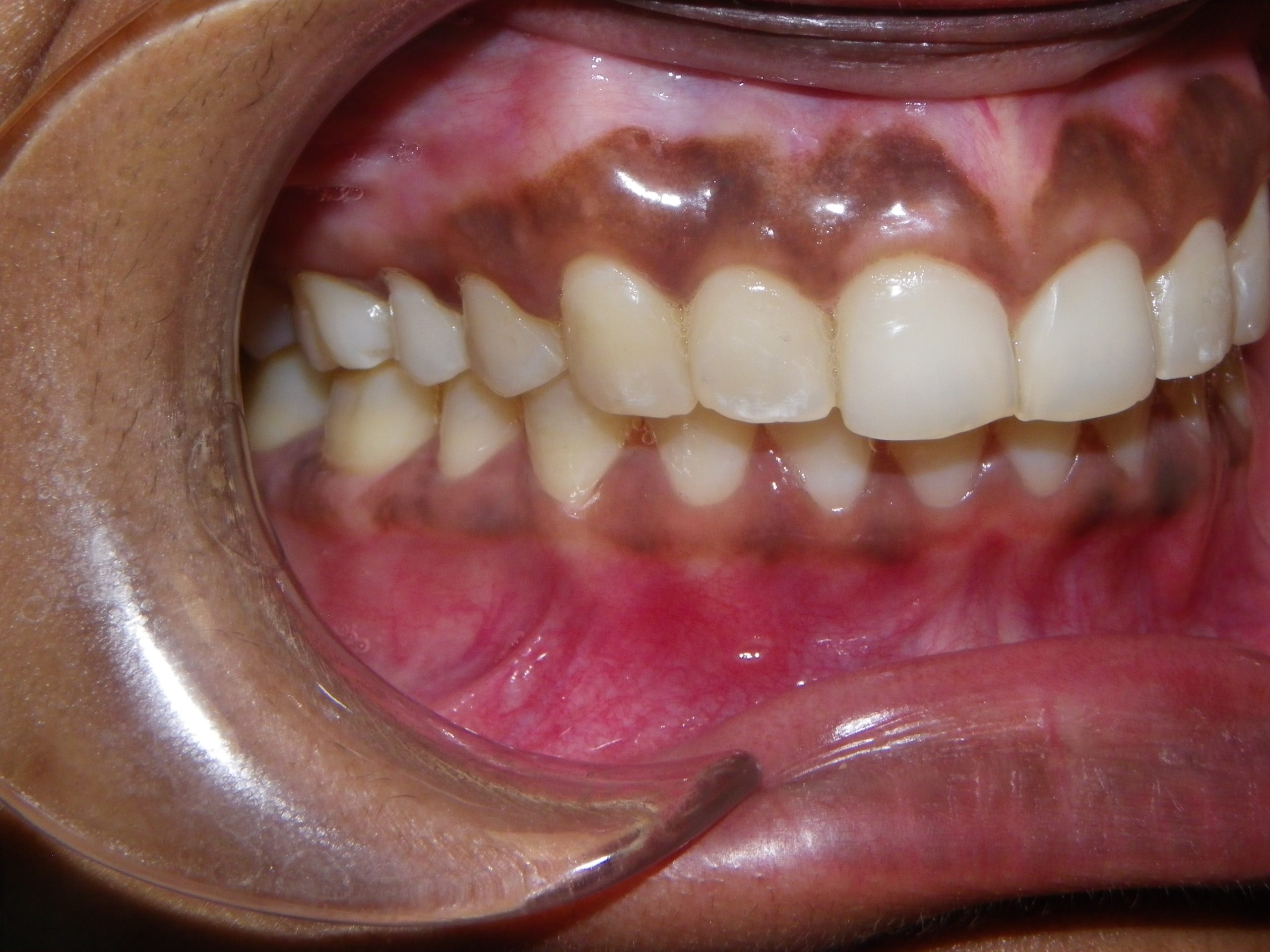 Dental mirror view of teeth during examination