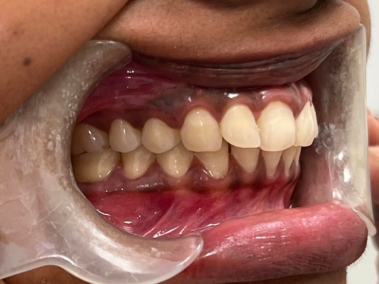 Lower teeth showing alignment and gum health