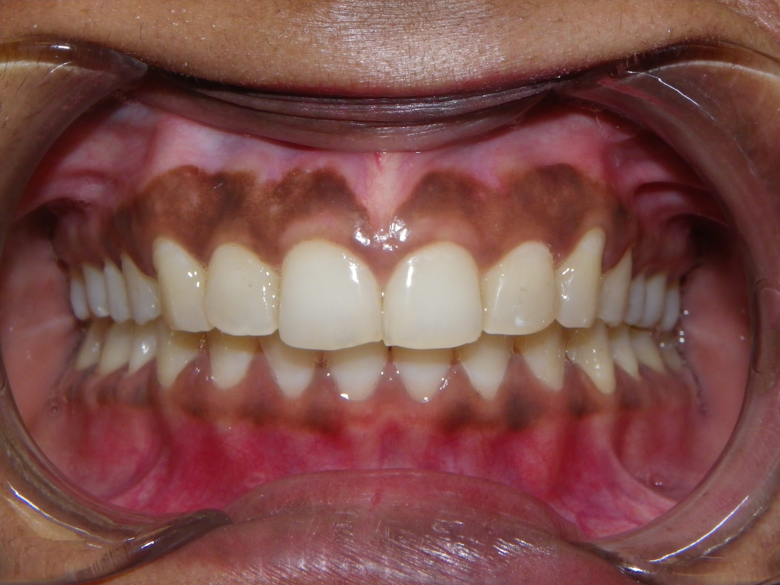 Side view of teeth showing bite positioning