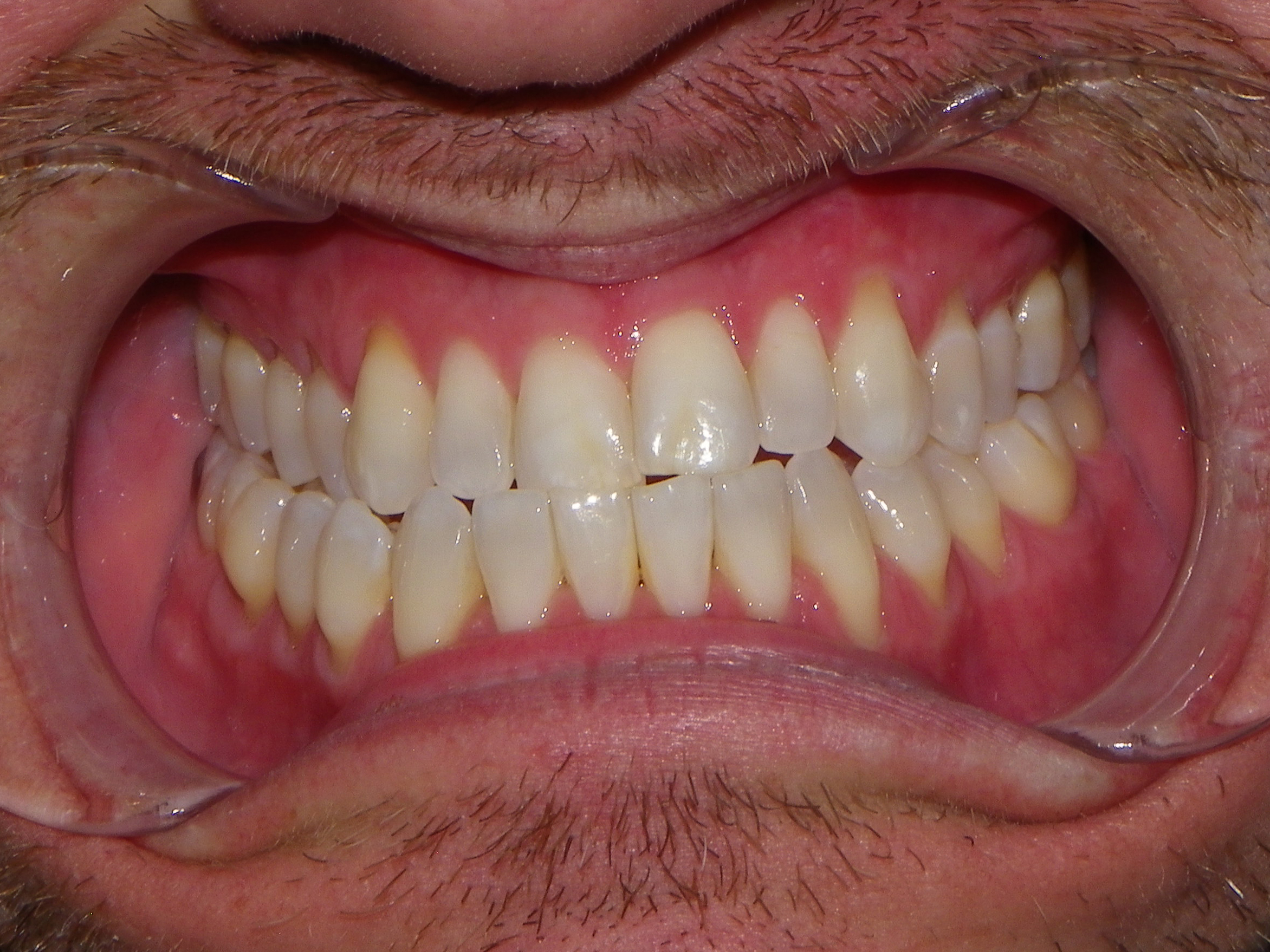 Close-up of teeth and gums during dental exam