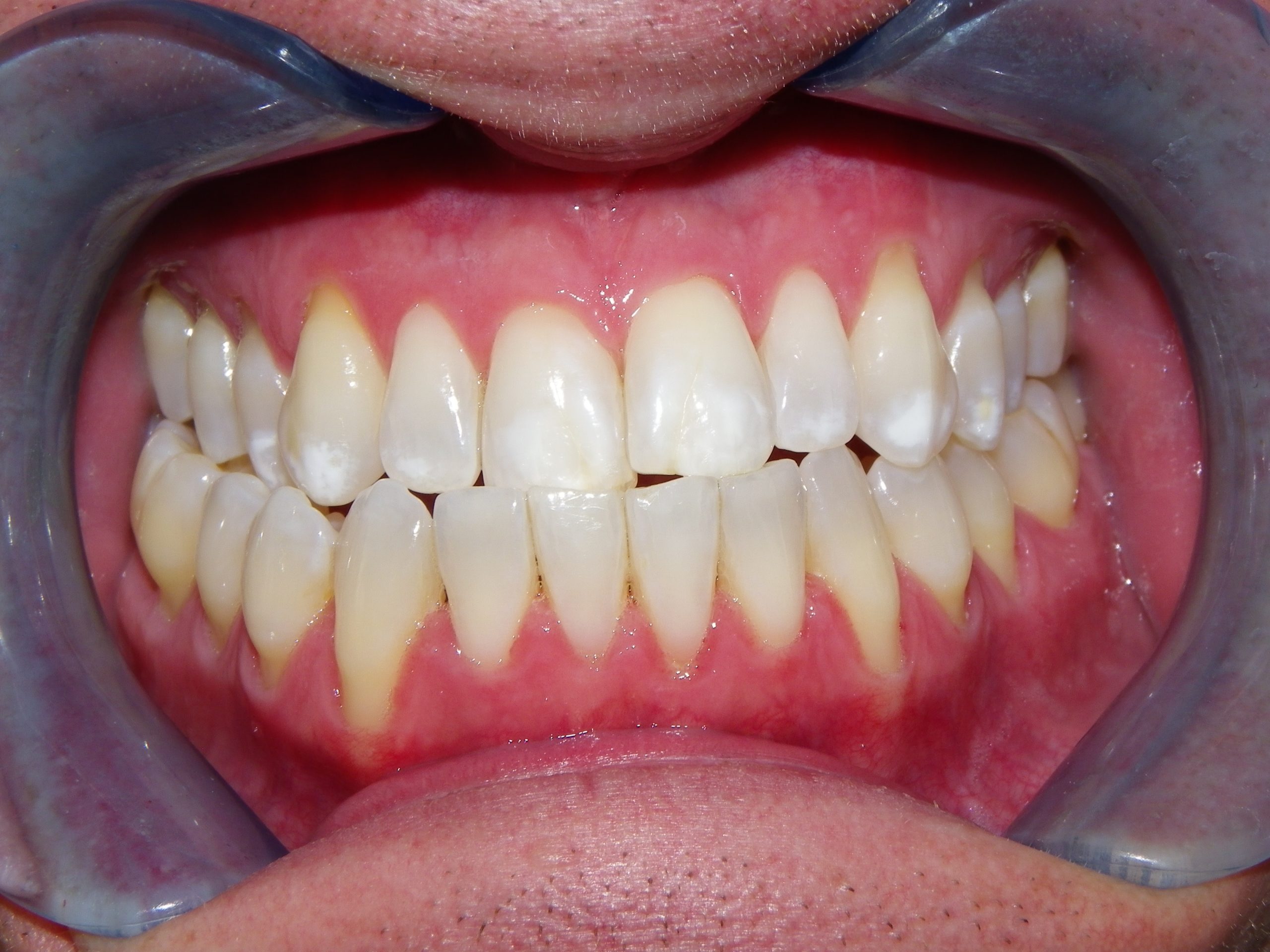Teeth in occlusion demonstrating bite relationship