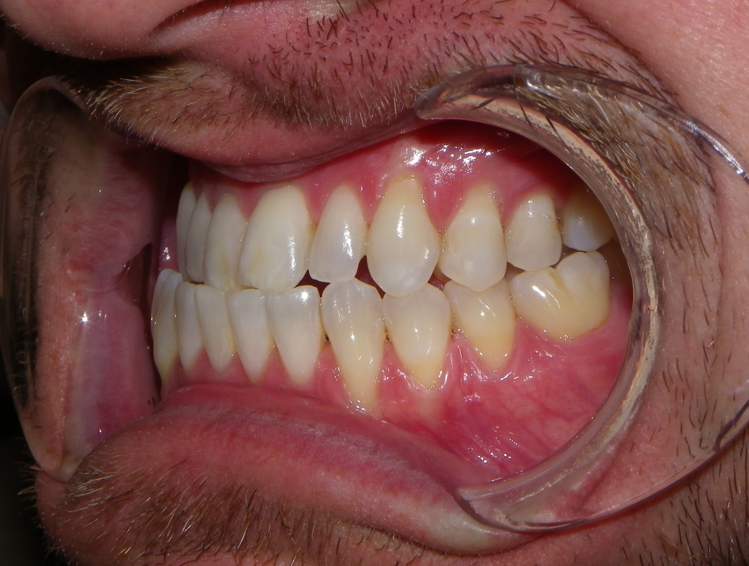 Intraoral photo showing bite alignment