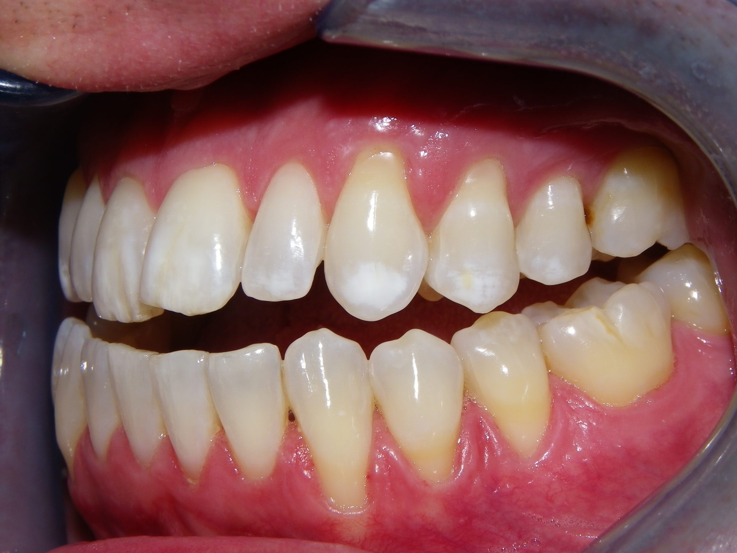 Close-up smile showing upper and lower teeth