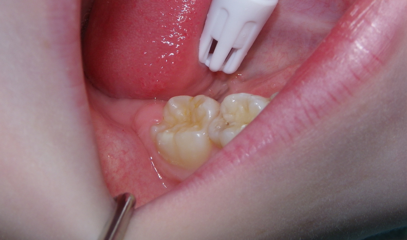 Dental X-ray image used for diagnosis