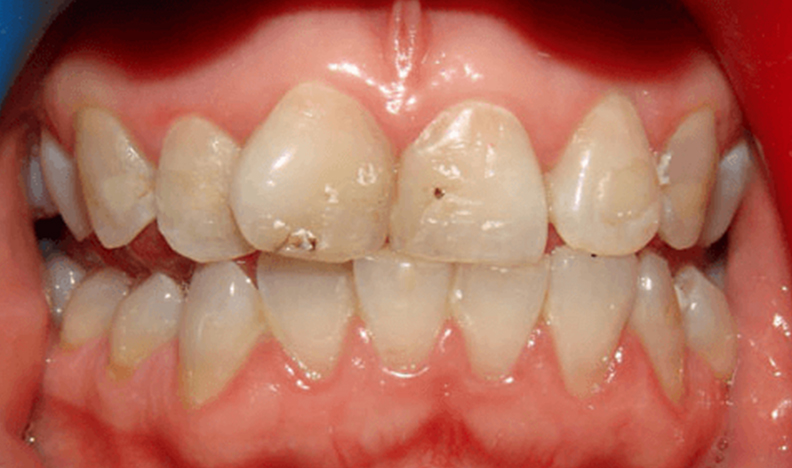 Dental instrument treating molar tooth